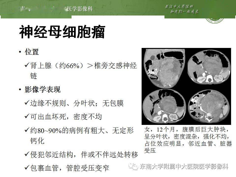 腹膜后神经源性肿瘤