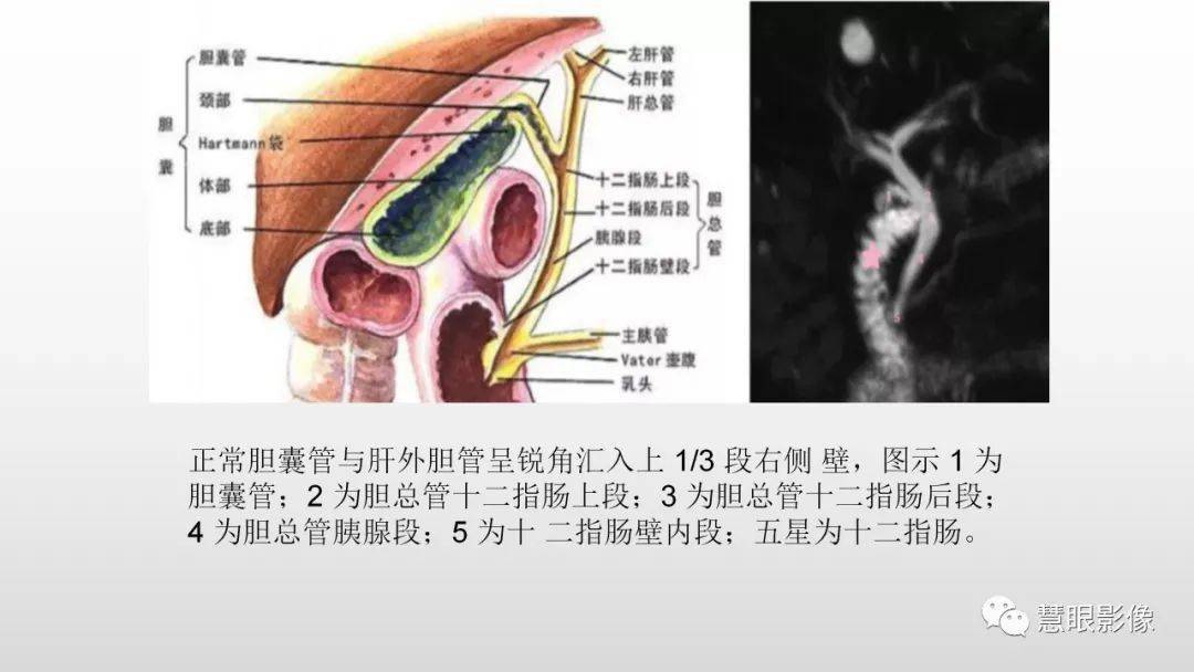 胆道解剖及先天变异