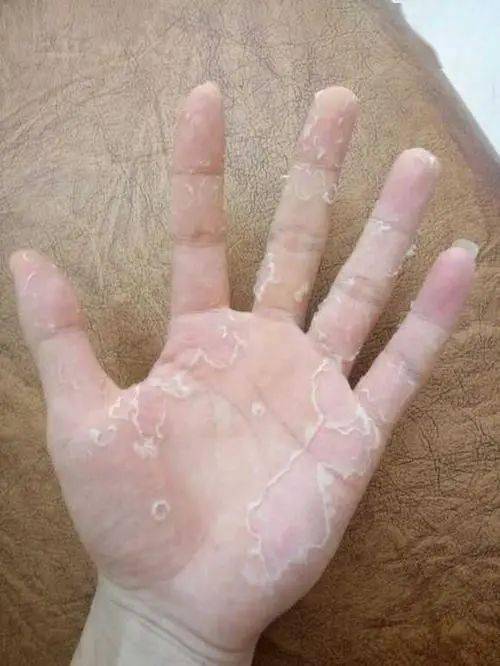 手癣:俗称" 鹅掌风" ,是指由皮肤癣菌引起的手部皮肤浅表真菌感染.
