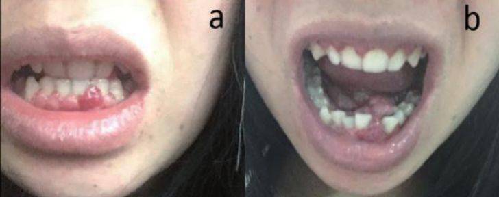 根尖片显示在左下前牙区牙槽骨吸收广泛吸收至根尖处,受累的31,32牙已