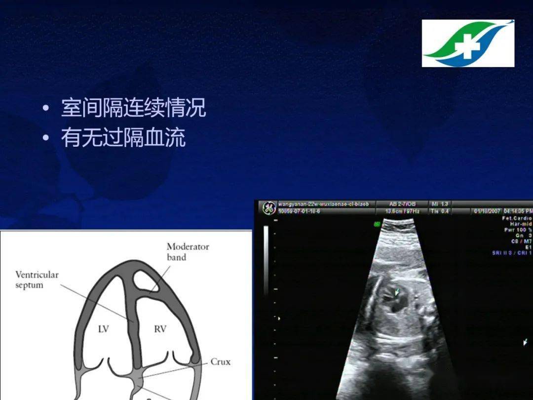 胎儿超声心动图基础及切面