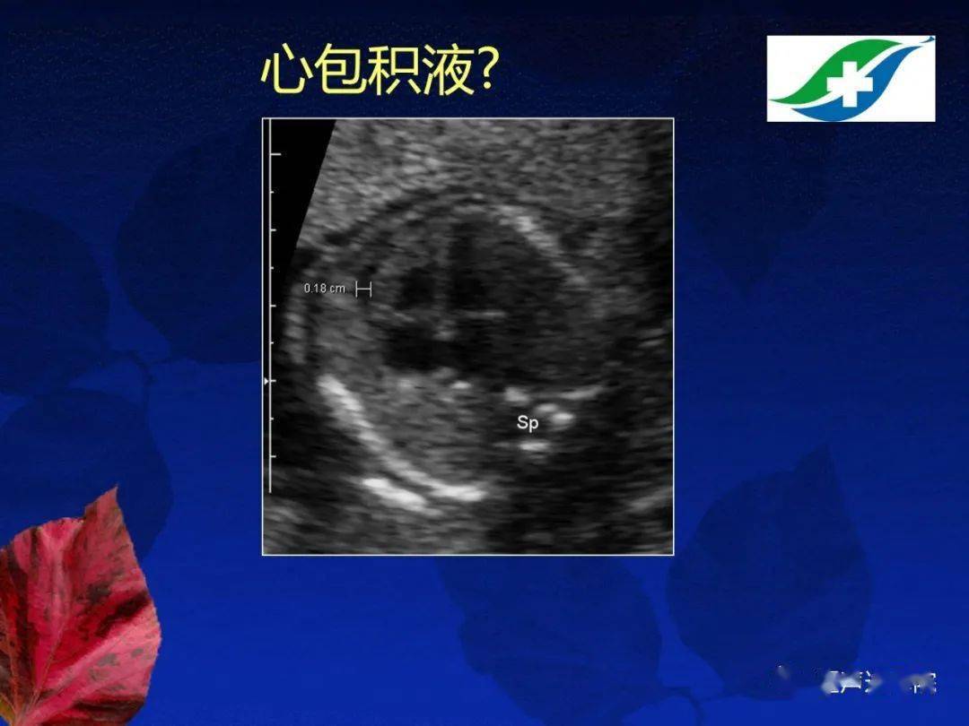 胎儿超声心动图基础及切面