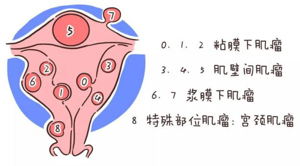 子宫肌瘤的治疗方案选择需综合考虑肌瘤的分型,患者年龄,临床症状