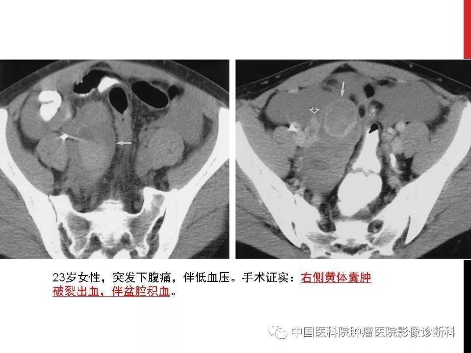 观察盆腔积液情况,了解怀孕情况及孕囊位置);·ct是必要补充(观察范围