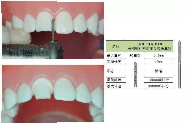 牙体预备全瓷冠标准化预备及车针使用技巧详解