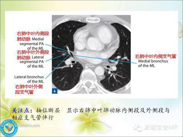 推荐丨肺动脉和肺静脉影像断层解剖