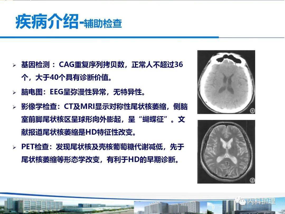 一例亨廷顿舞蹈病患者护理查房_治疗