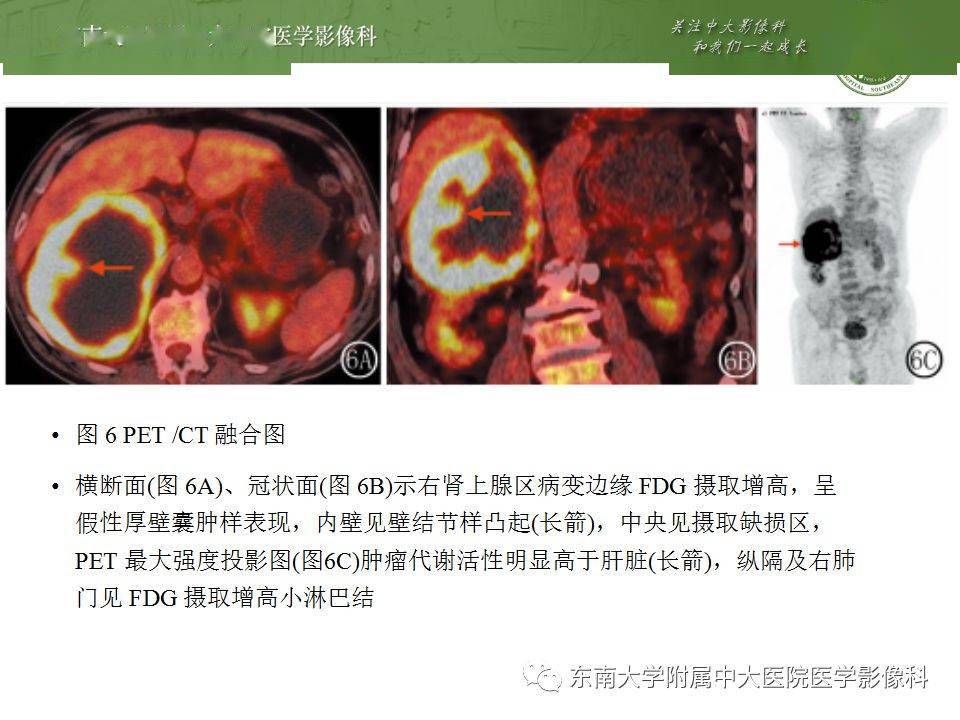 腹部| 肾上腺皮质癌影像诊断