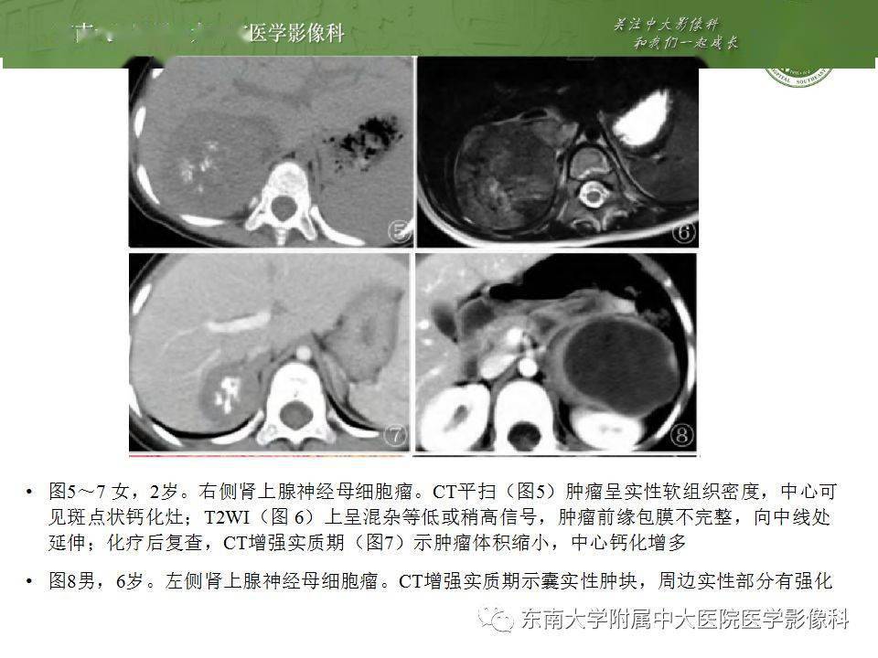 腹部| 肾上腺皮质癌影像诊断