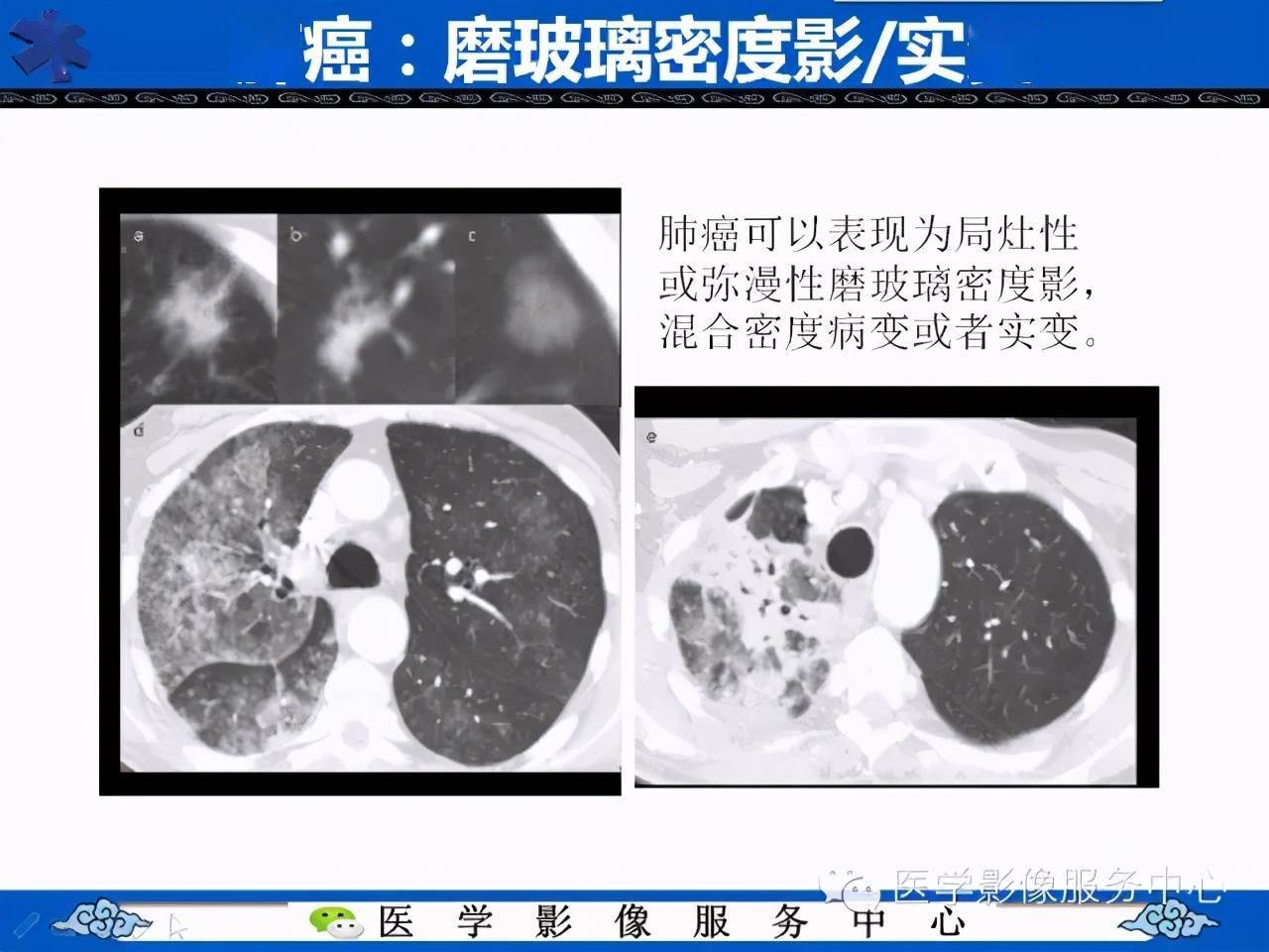 肺癌的影像学鉴别诊断实例:哪些不是肺癌