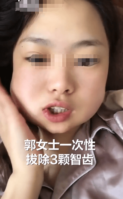 山东一女子把3颗智齿一次性拔完:手术中途吓哭,脸肿得