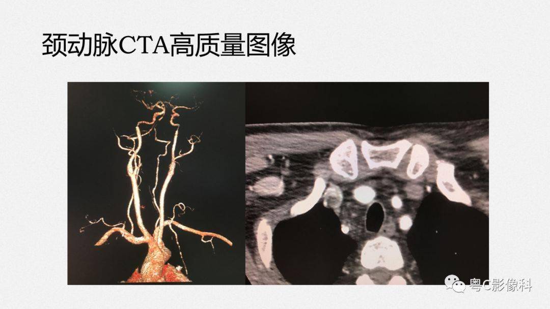 颈动脉cta检查—how to do well?