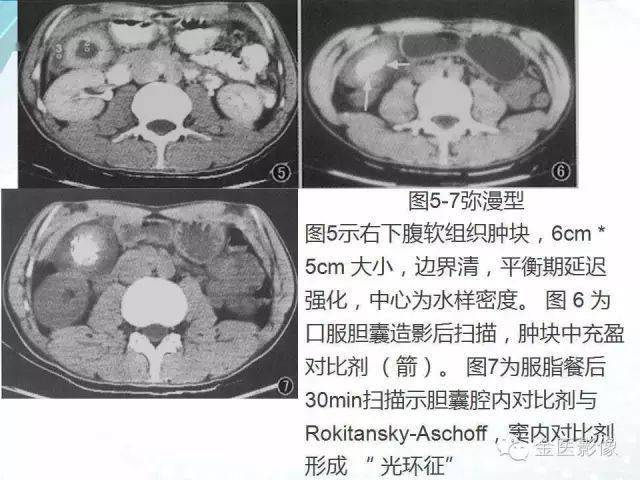 胆囊腺肌症影像表现及鉴别