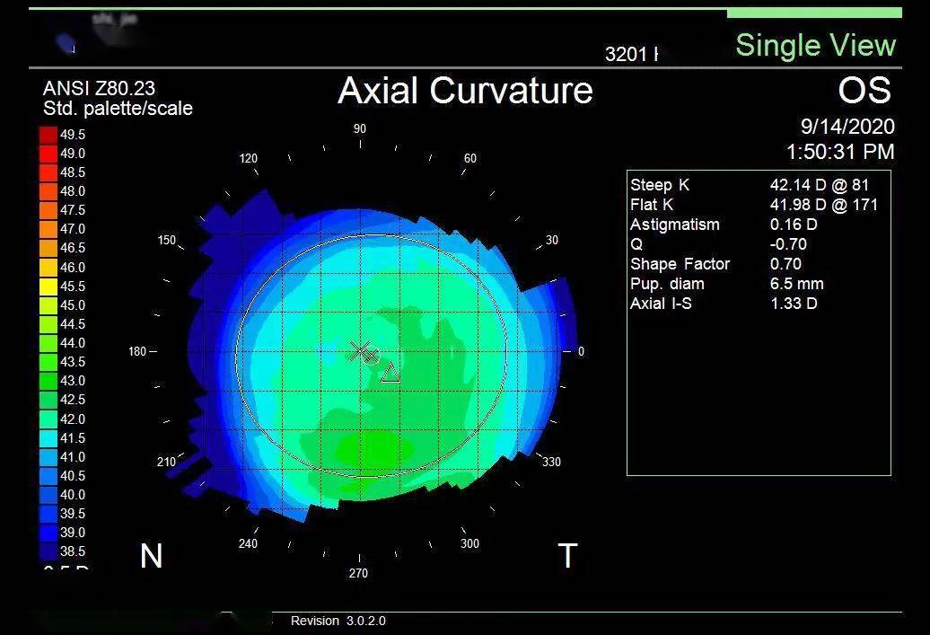 术前左眼角膜地形图kappa角:x 0.3mm,y-0.
