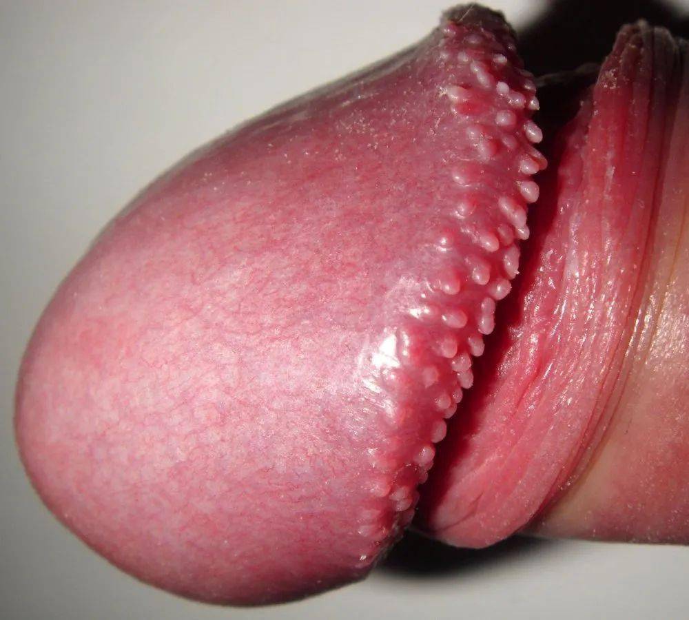 pearly penile papules,ppp),又称为「  珍珠疹」「yin茎珍珠状丘疹病