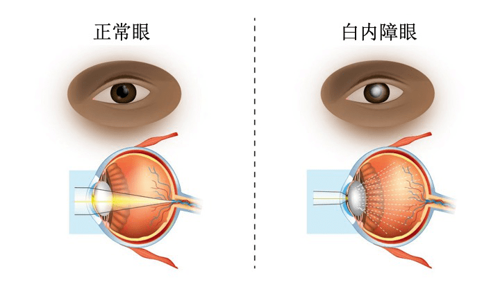 【爱眼护眼9】"老花眼"好转是发生"白内障"了吗?