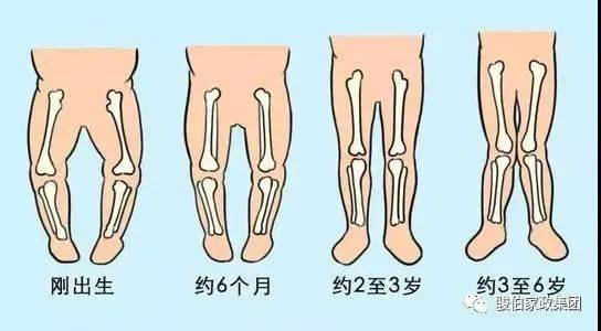 一般10岁左右,大约有95%宝宝的"x"型腿外观上是能够恢复到正常的