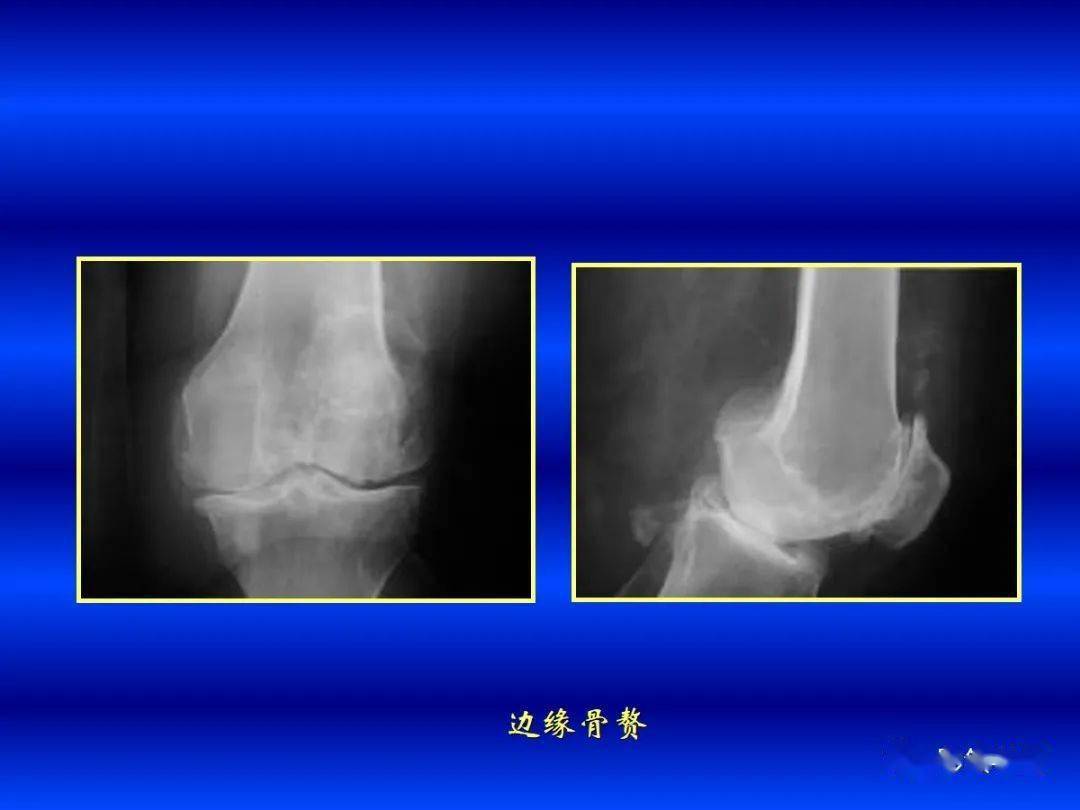 超全!各种关节炎的影像学表现