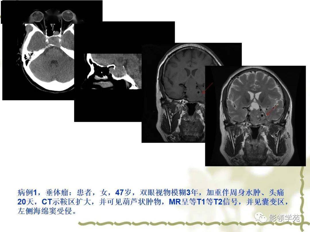 海绵窦解剖及常见疾病影像诊断