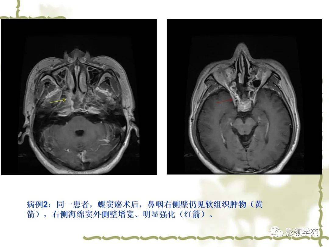 海绵窦解剖及常见疾病影像诊断