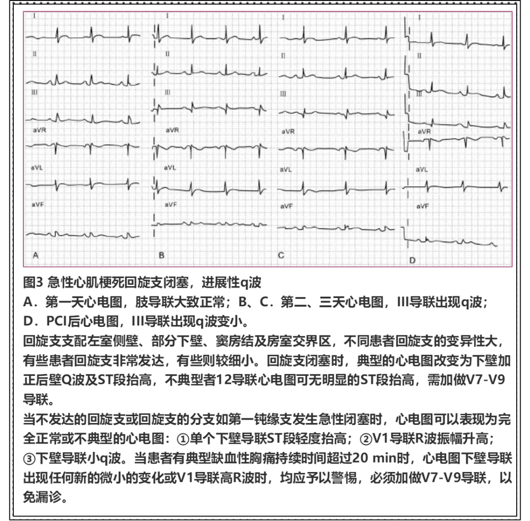 心梗不典型心电图:18个图例练就火眼金睛