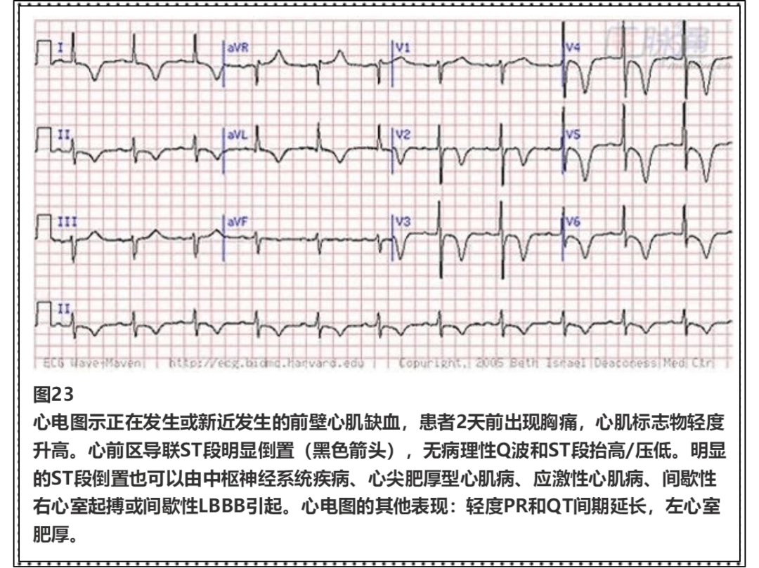 心梗不典型心电图:18个图例练就火眼金睛