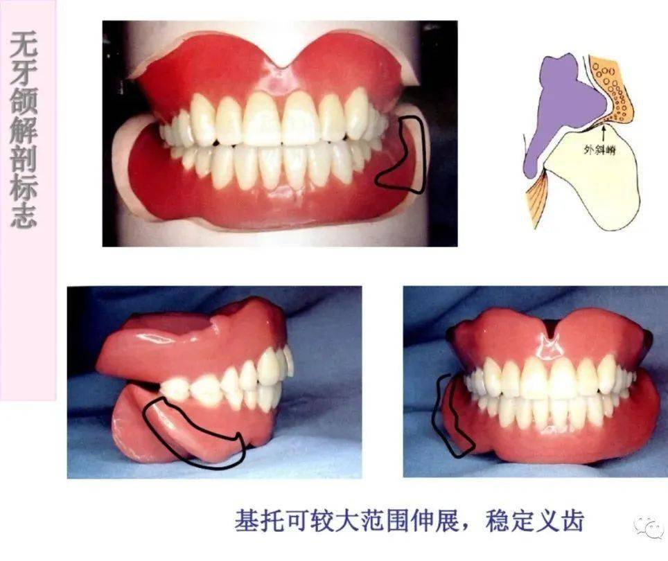 干货无牙颌解剖标志