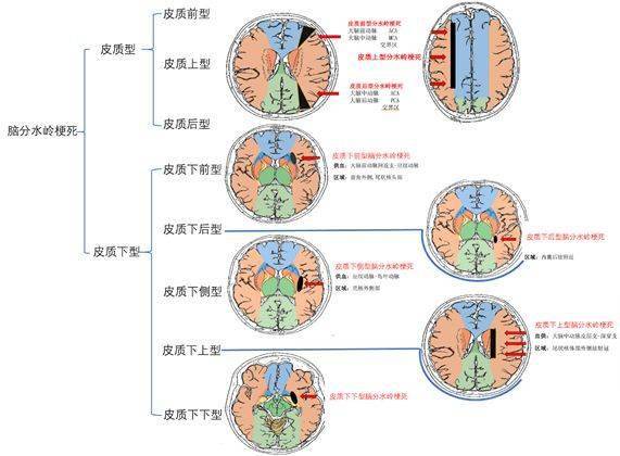 一文读懂干货:脑分水岭梗死的解剖和分型!