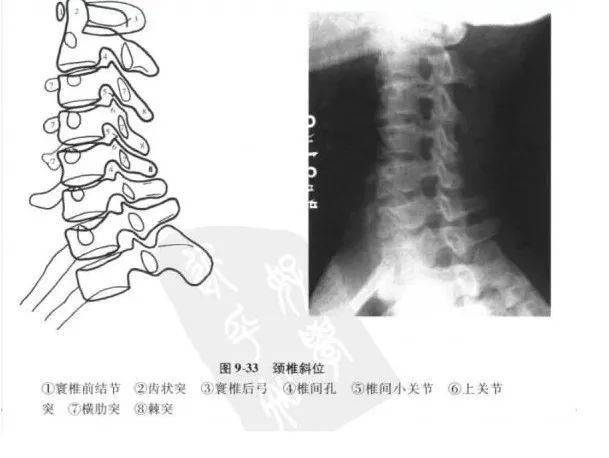 上位颈椎x光片,张口位 1 枢椎之齿突,2 寰枢之外侧块,3 寰枢关节,4