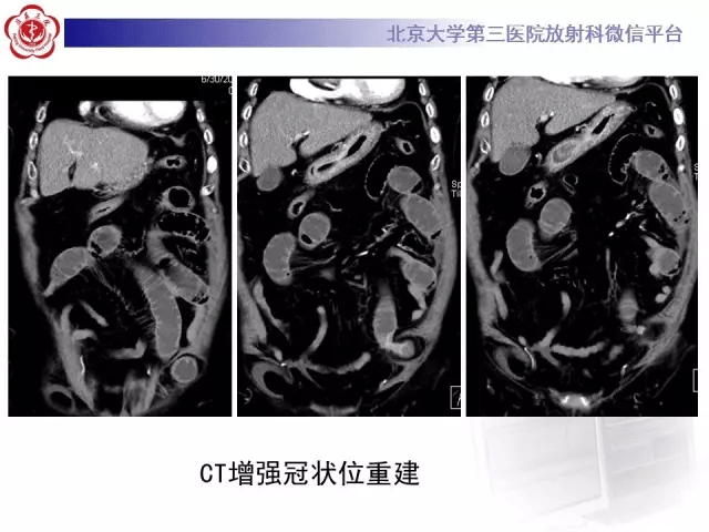 急诊你一定要知道的"半月线疝"