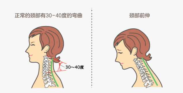 我们的颈椎正常情况下其实一直是弯的,叫生理曲度