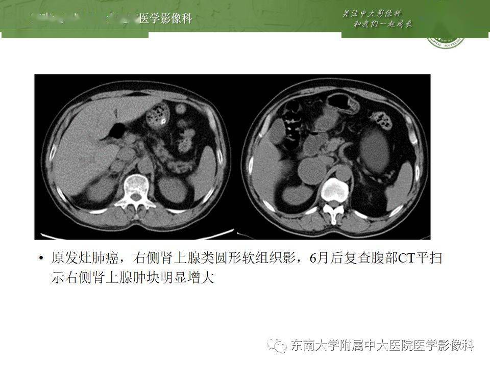 肾上腺嗜铬细胞瘤ct诊断与鉴别诊断