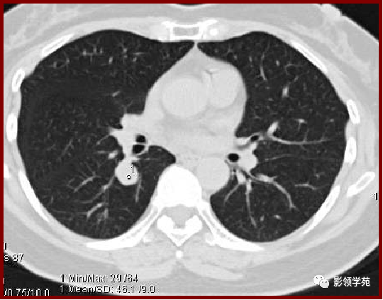 肺纤维瘤肺内脂肪瘤肺内脂肪瘤是极为罕见的肺内良性肿瘤,好发于中年