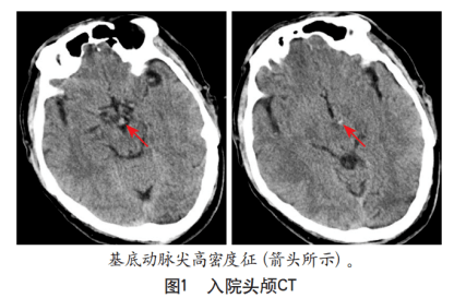 扩张型心肌病伴发脑栓塞急性期溶栓治疗1例报告