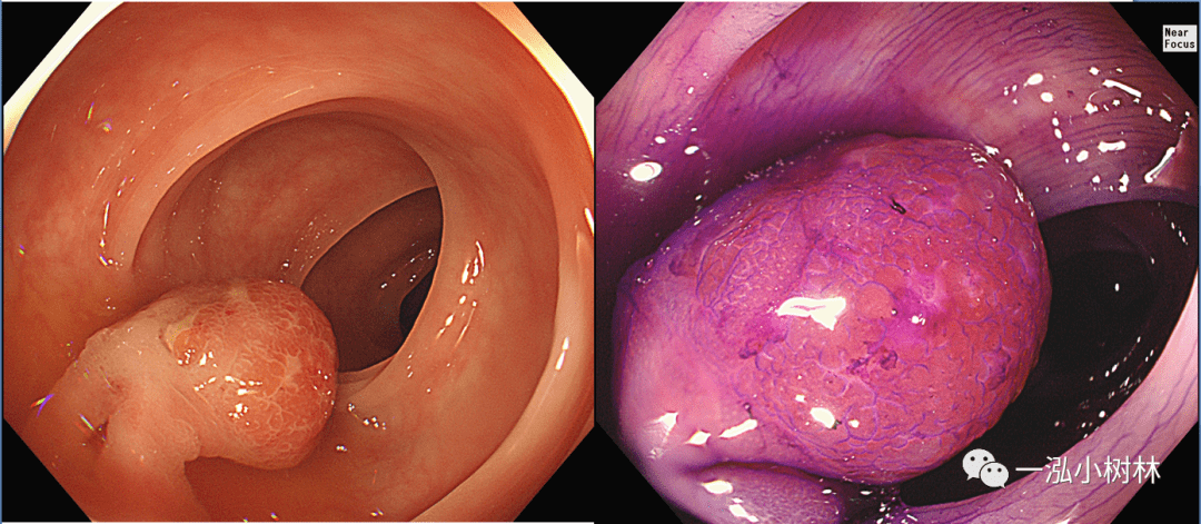 结肠息肉图谱