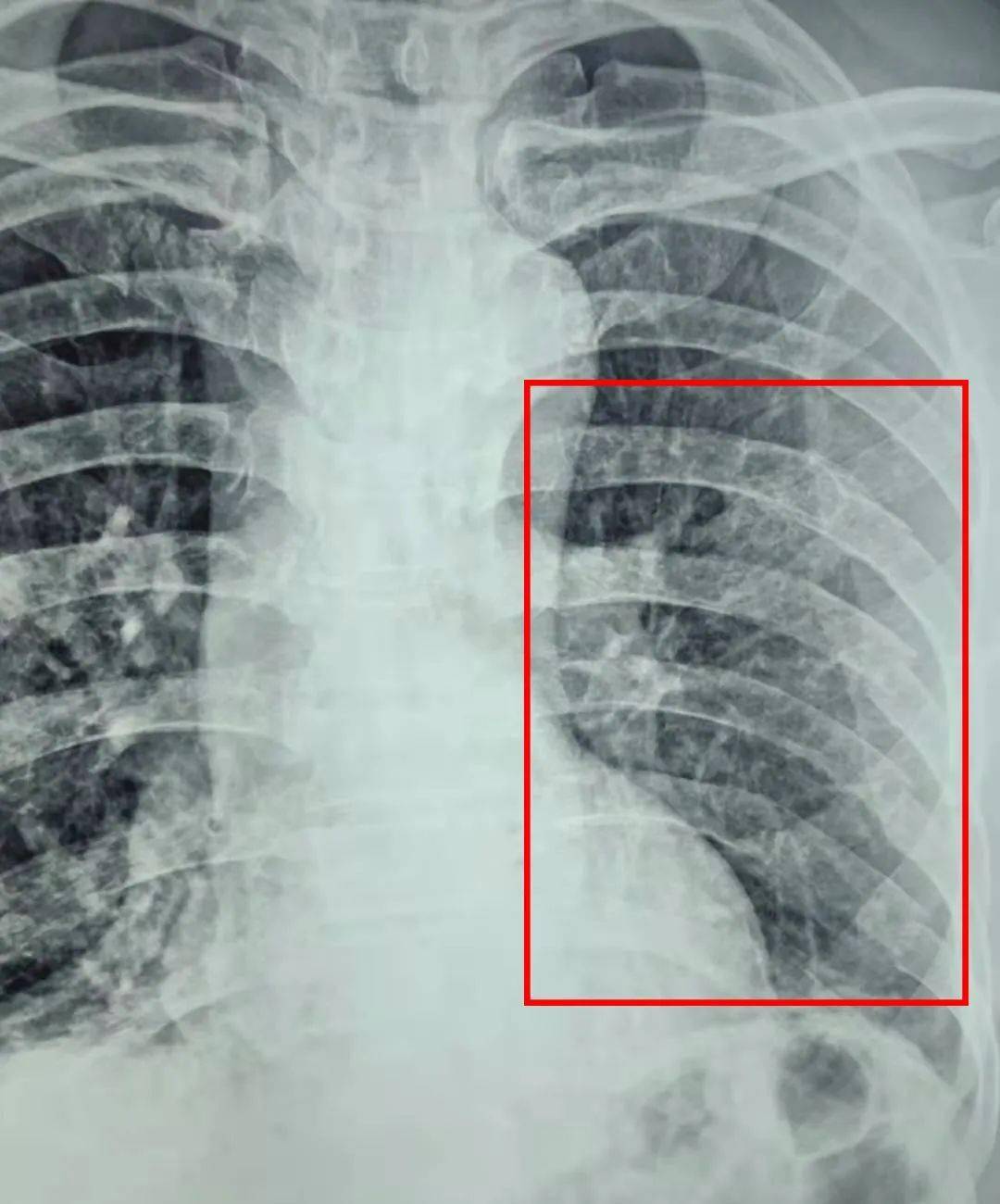 病例24 肋骨骨折-临床影像诊断-医学