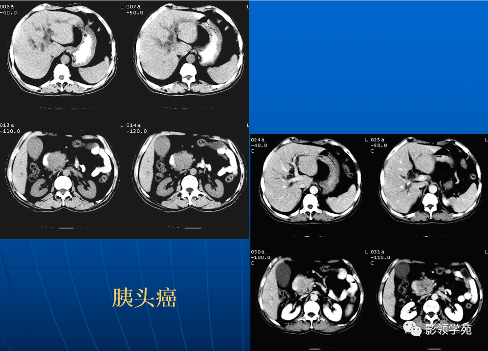 9种胰腺常见疾病的ct诊断