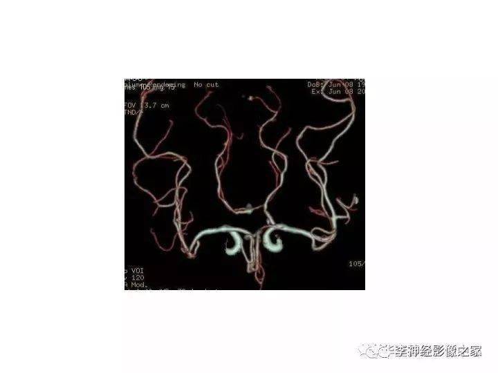 cta详细解读:头颈部血管解剖及正常变异