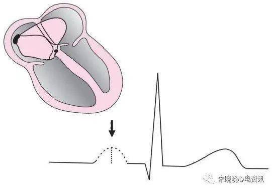 切迹或"结 节",st 段有无突起,t 波有无变形等,确定其是否 为隐没的 p