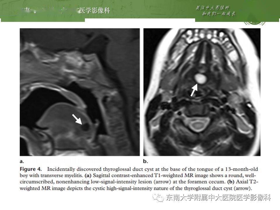 异位甲状腺,甲状舌管囊肿影像表现