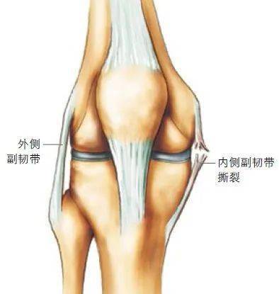 和外侧副韧带(lcl)损伤内侧副韧带(mcl)4交叉韧带损伤的治疗方案是