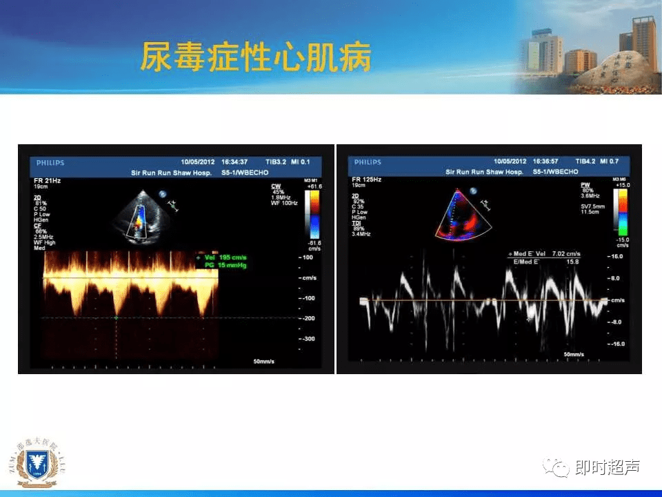 左室肥厚的超声心动图诊断思路