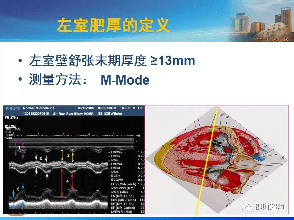 左室肥厚的超声心动图诊断思路