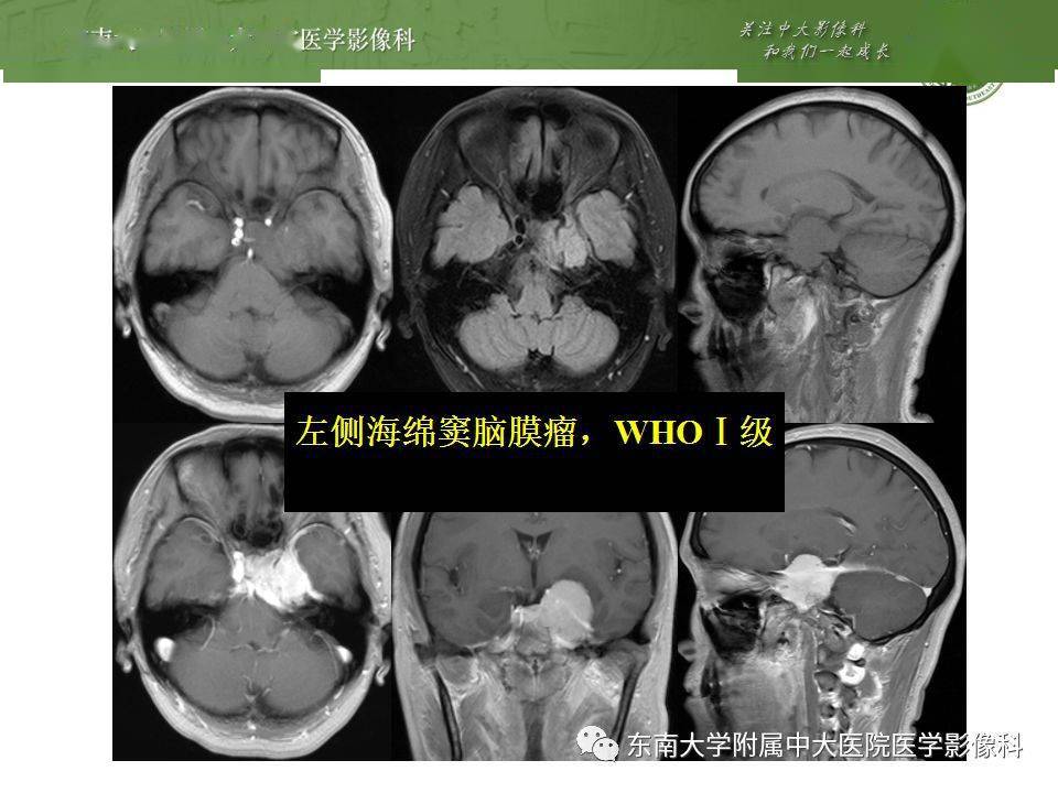 海绵窦区常见肿瘤垂体瘤三叉神经鞘瘤