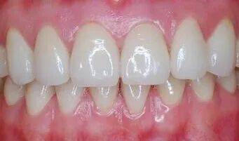 健康的口腔包括:  牙齿清洁,无龋洞,无痛感,牙龈颜色正常,无出血现象.