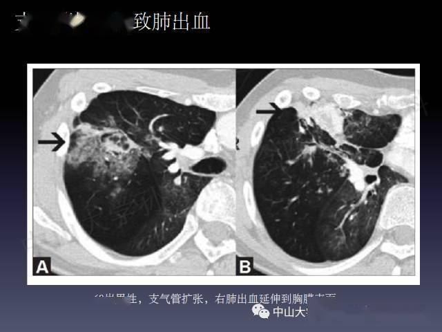 肺出血的影像学特征