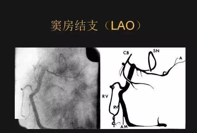 冠状动脉解剖—精细到每一个分支