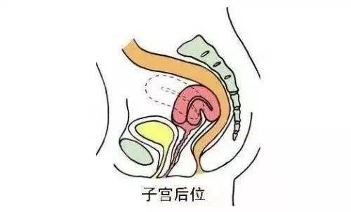 后位子宫不容易怀孕吗?