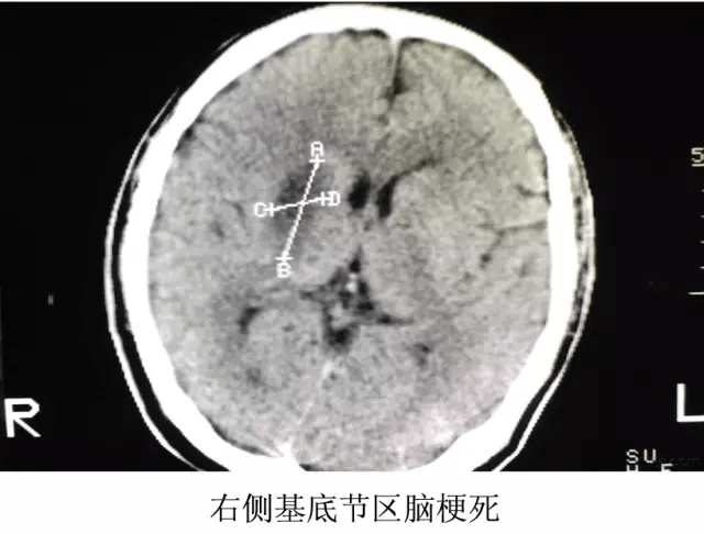 影像医生必须掌握的头颅ct解剖与常见出血梗死判读