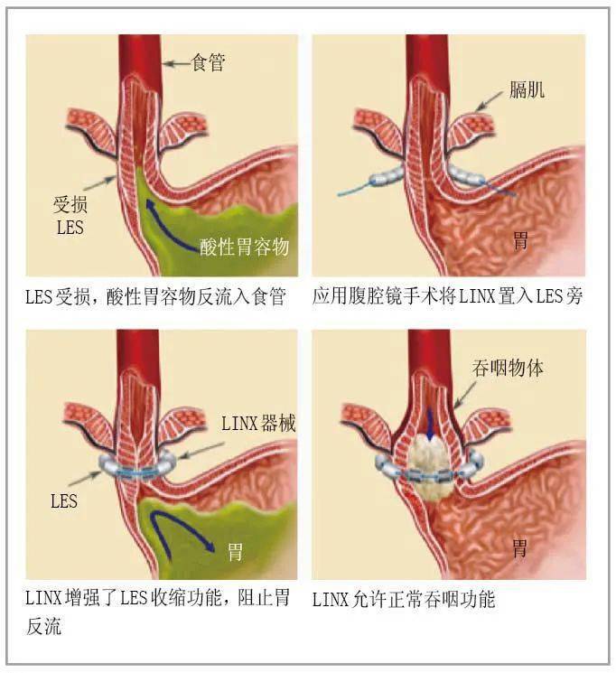 疾病科普丨难以言说的酸楚反流性食管炎